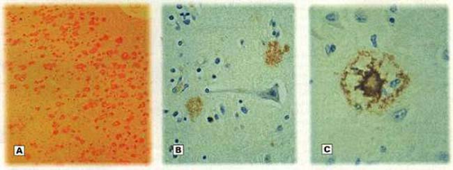 Fig. 3 : Ejemplos de la forma en que se deposita el amiloideb en el cerebro. A) Placas neuríticas que han invadido masivamente la corteza cerebral (Aumento: 40x). B) Localización extraneuronal de las placas neuríticas. C) Se observa la zona compacta central de sustancia amiloide en una placa neurítica (Aumento 200x)