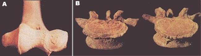 A) Región del codo (epífisis distal del húmero) que muestra dos áreas de porosidad provocadas por osteoartritis. B) Dos vértebras lumbares que muestran formación de osteofitos irregulares (picos de papagayo) en los márgenes superiores.